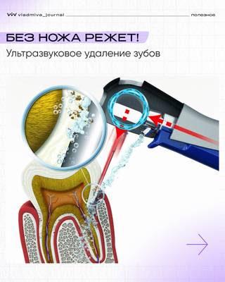 Пьезохирургия: мягкое удаление зубов без травм.